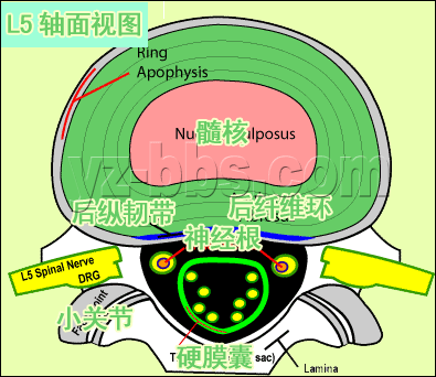 [转载]【推荐】学会看腰椎间盘突出CT和MRI磁共振片子的超好