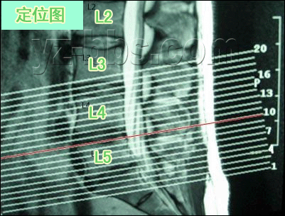 [转载]【推荐】学会看腰椎间盘突出CT和MRI磁共振片子的超好