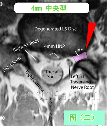 [转载]【推荐】学会看腰椎间盘突出CT和MRI磁共振片子的超好