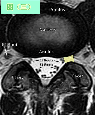 [转载]【推荐】学会看腰椎间盘突出CT和MRI磁共振片子的超好