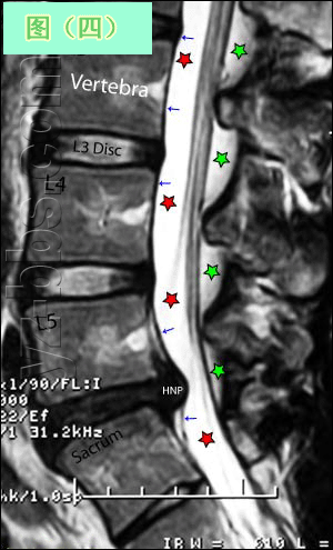 [转载]【推荐】学会看腰椎间盘突出CT和MRI磁共振片子的超好