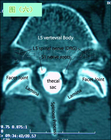 [转载]【推荐】学会看腰椎间盘突出CT和MRI磁共振片子的超好
