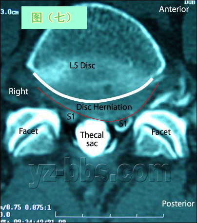 [转载]【推荐】学会看腰椎间盘突出CT和MRI磁共振片子的超好