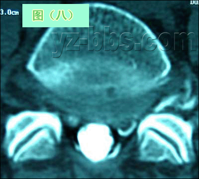 [转载]【推荐】学会看腰椎间盘突出CT和MRI磁共振片子的超好