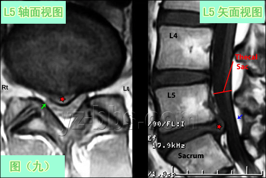 [转载]【推荐】学会看腰椎间盘突出CT和MRI磁共振片子的超好
